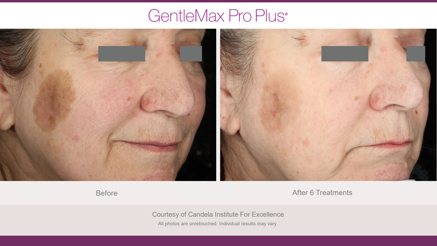 Candela GentleMax Pro Plus before and after reference for facial fine lines and texture