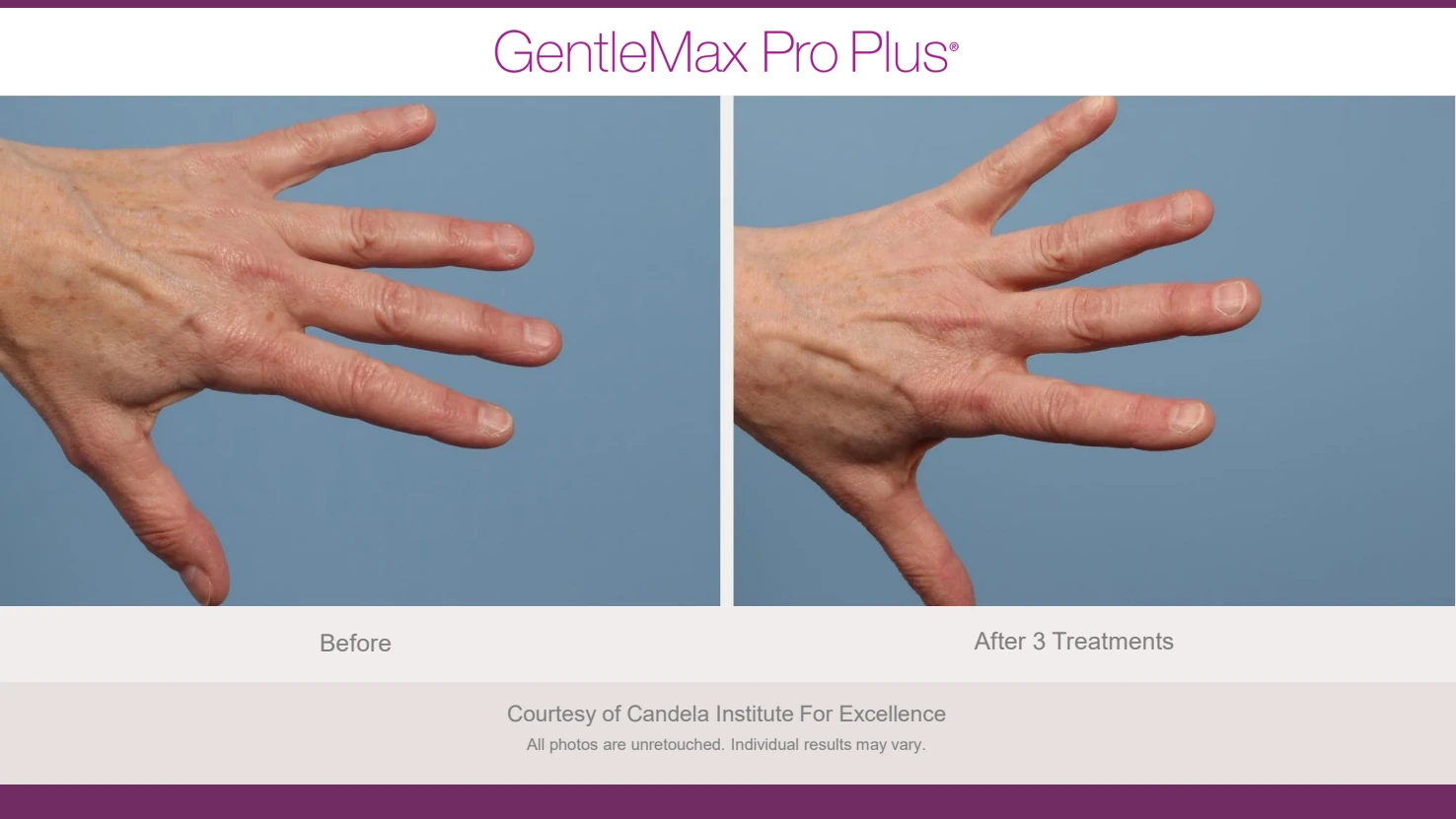 Candela GentleMax Pro Plus before and after reference for hand pigmentation