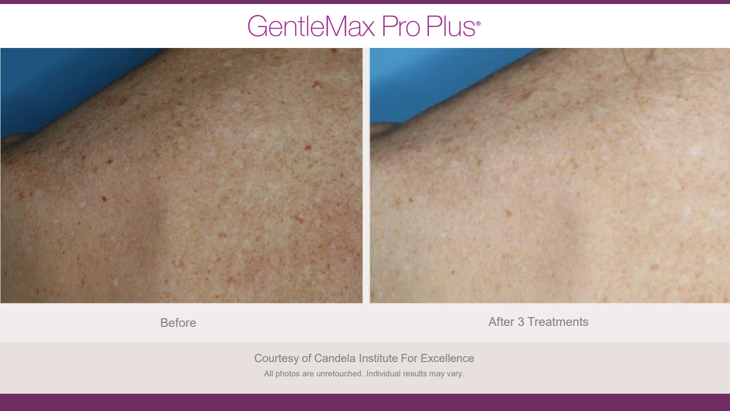 Candela GentleMax Pro Plus before and after reference for sun spots and pigment