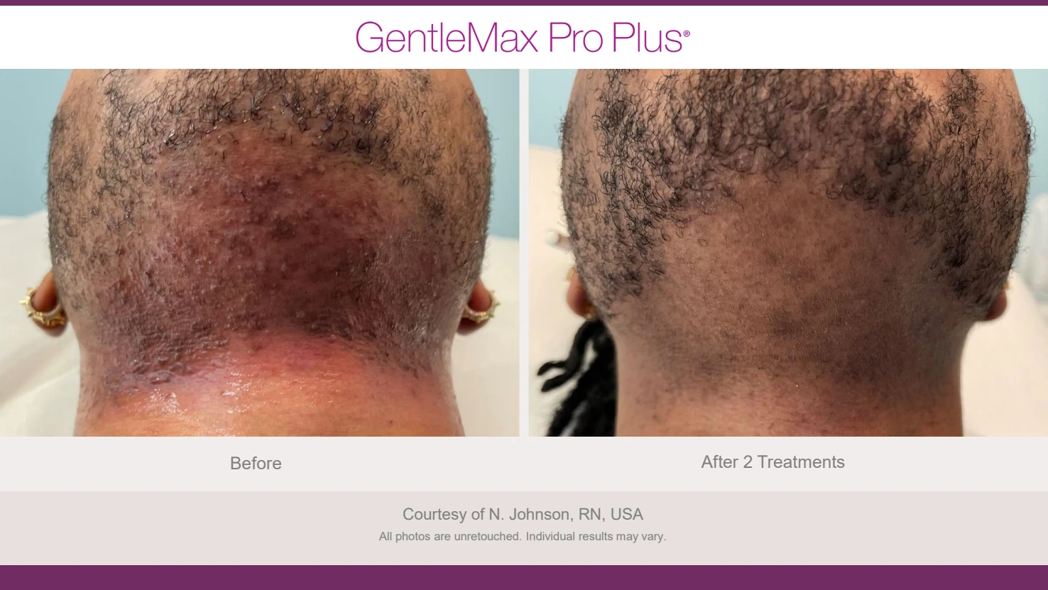 Candela GentleMax Pro Plus before and after reference for neck hair and razor bump concerns