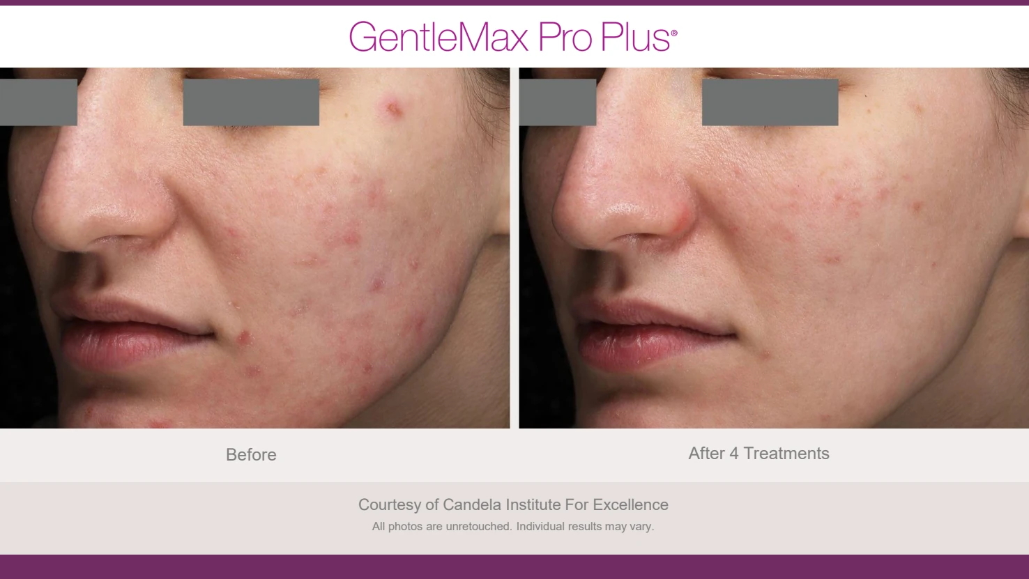 Candela GentleMax Pro Plus before and after reference for facial redness