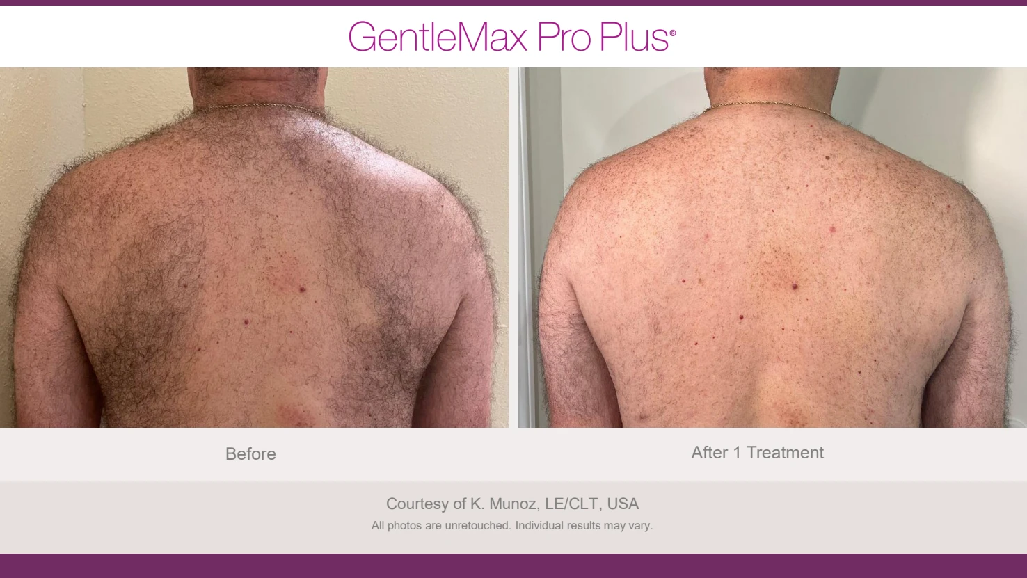 Candela GentleMax Pro Plus before and after reference for back hair reduction