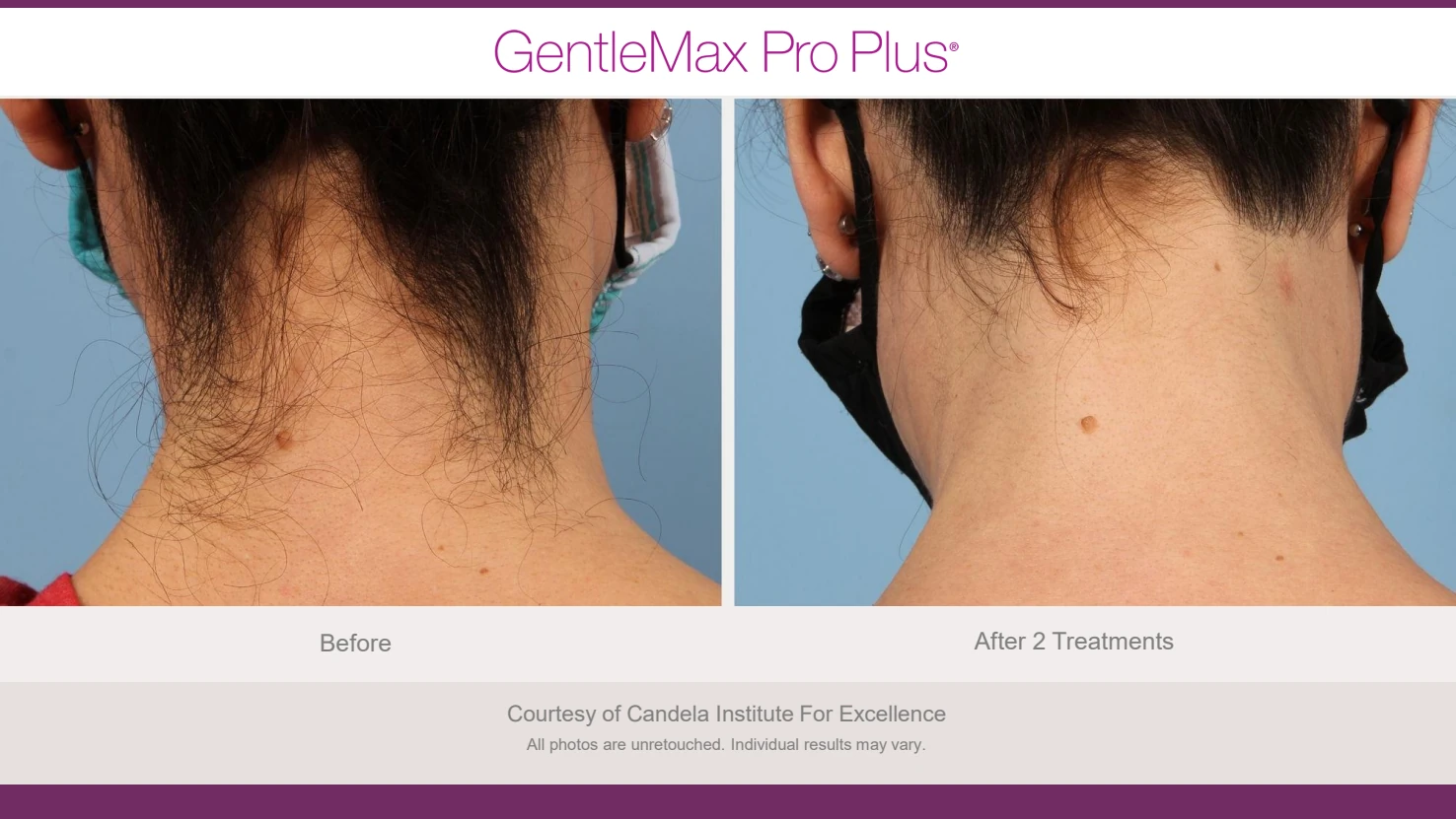 Candela GentleMax Pro Plus before and after reference for neck hair reduction