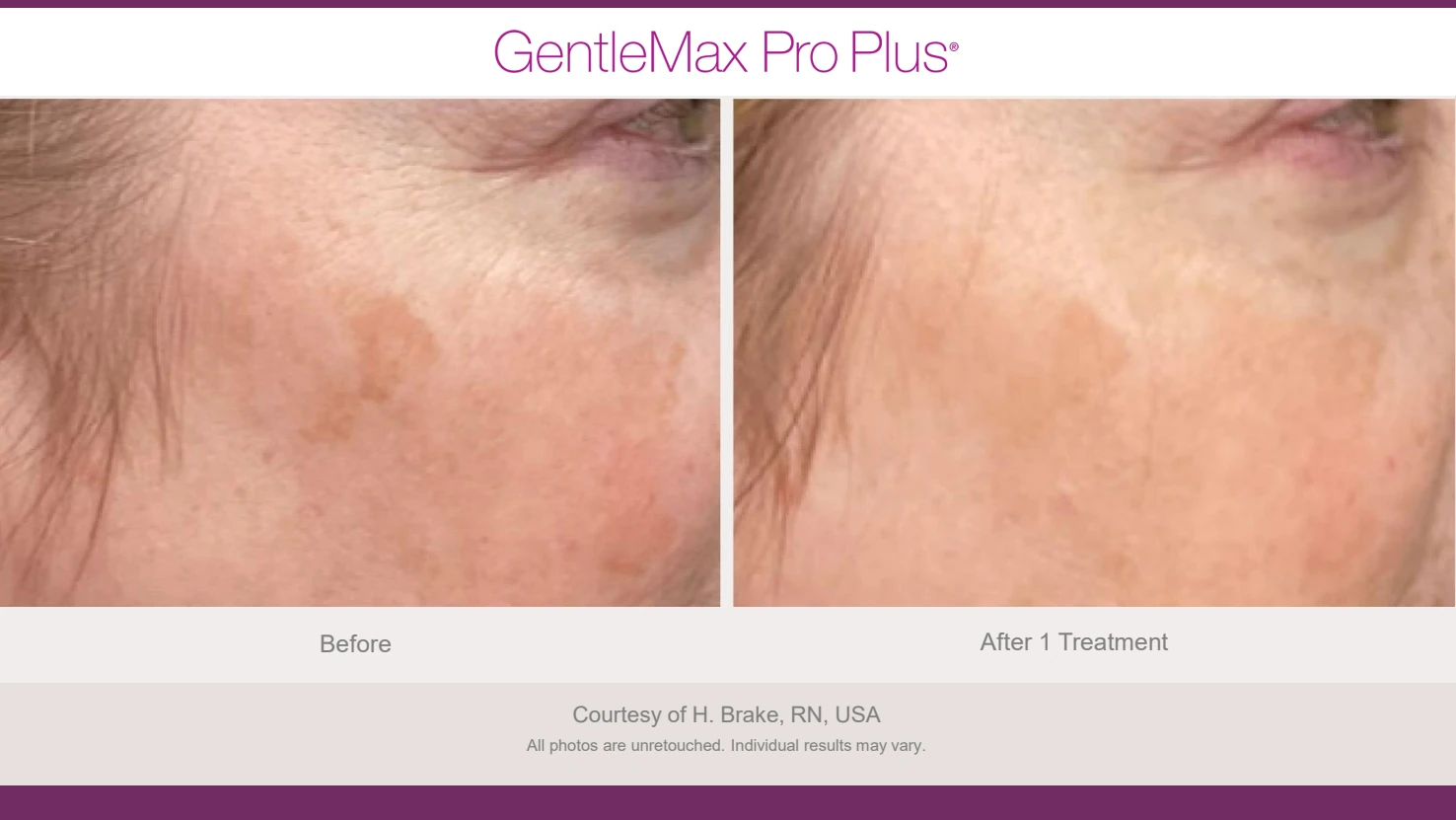 Candela GentleMax Pro Plus before and after reference for vascular redness
